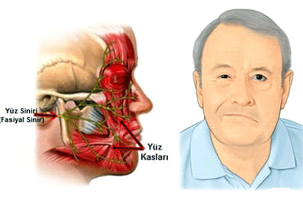 yüz felci nedir